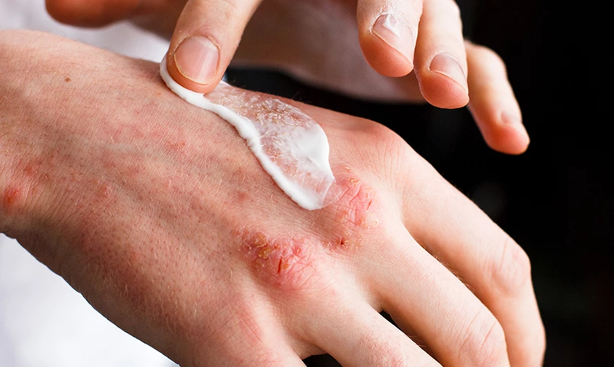 Traitez l'eczéma avec Cremicort Traitez l'eczéma avec Cremicort